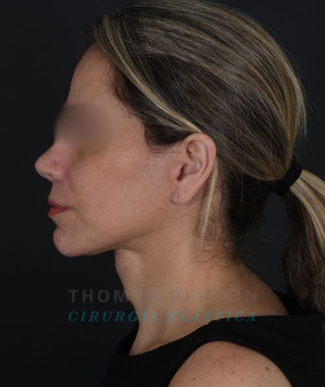 Resultado de um Deep Plane, Deep Neck, Enxertia, Laser CO2, Liplift e Suspenção de sobrancelha