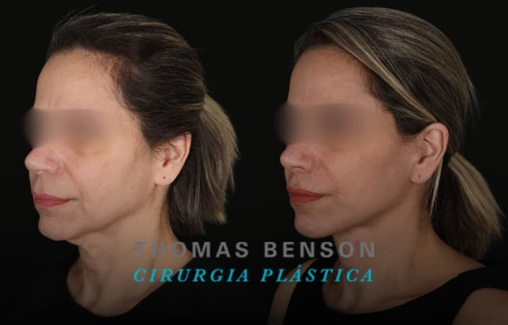 Resultado de um Deep Plane, Deep Neck, Enxertia, Laser CO2, Liplift e Suspenção de sobrancelha