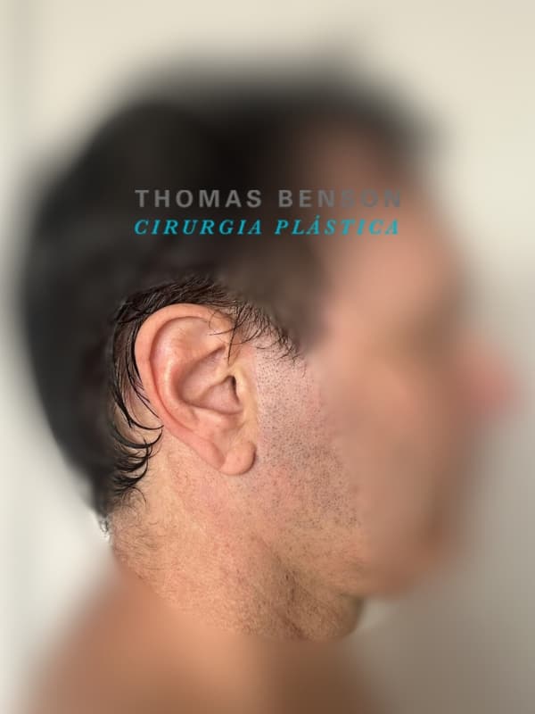 Cicatriz de procedimento realizado pelo Dr. Thomas Benson