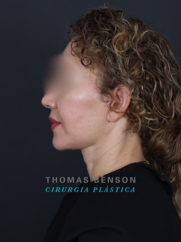 Cicatriz de procedimento realizado pelo Dr. Thomas Benson